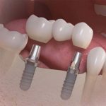 Имплантация зубов в Москве: опыт и качество в клинике “Доктор Лопатин”